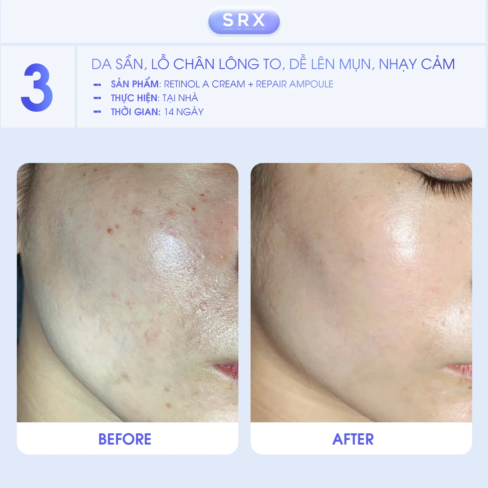 Feedback SRX Case lâm sàng điều trị các vấn đề trên da cùng bộ sản phẩm SRX 5