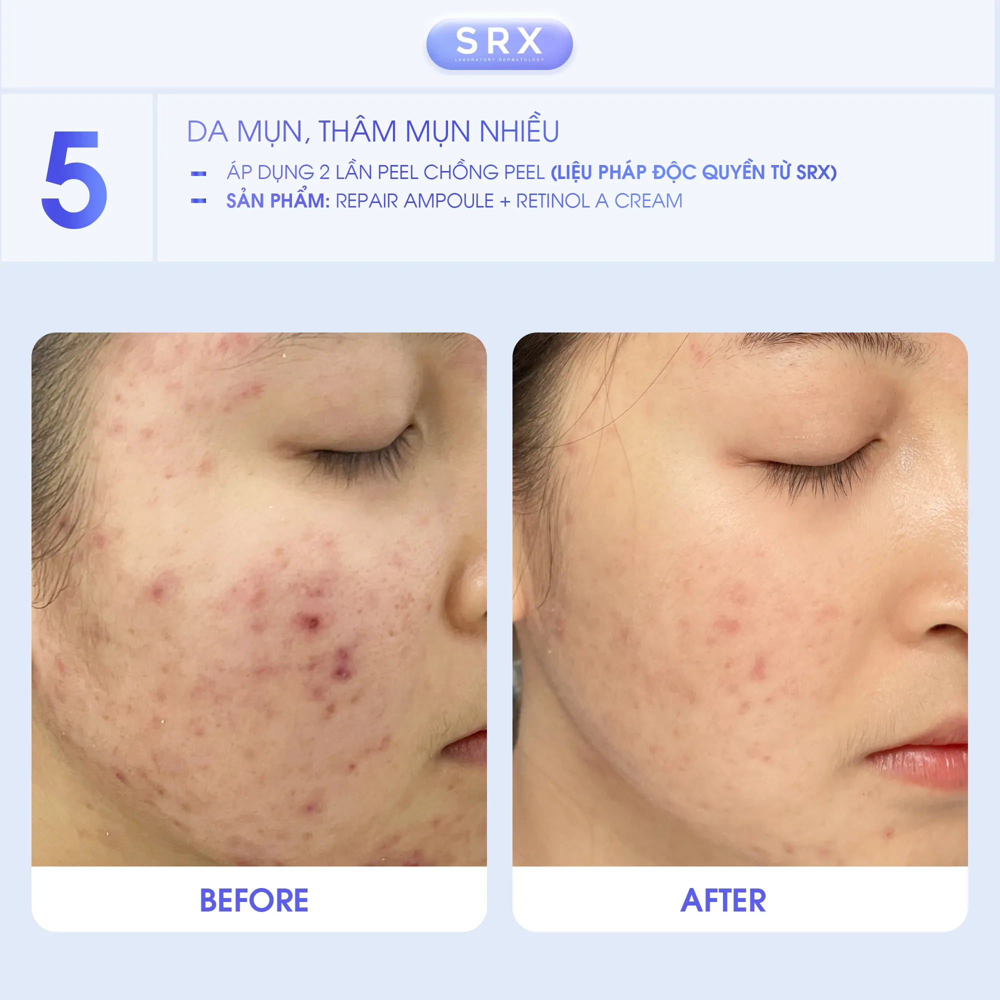 Feedback SRX Case lâm sàng điều trị các vấn đề trên da cùng bộ sản phẩm SRX 7