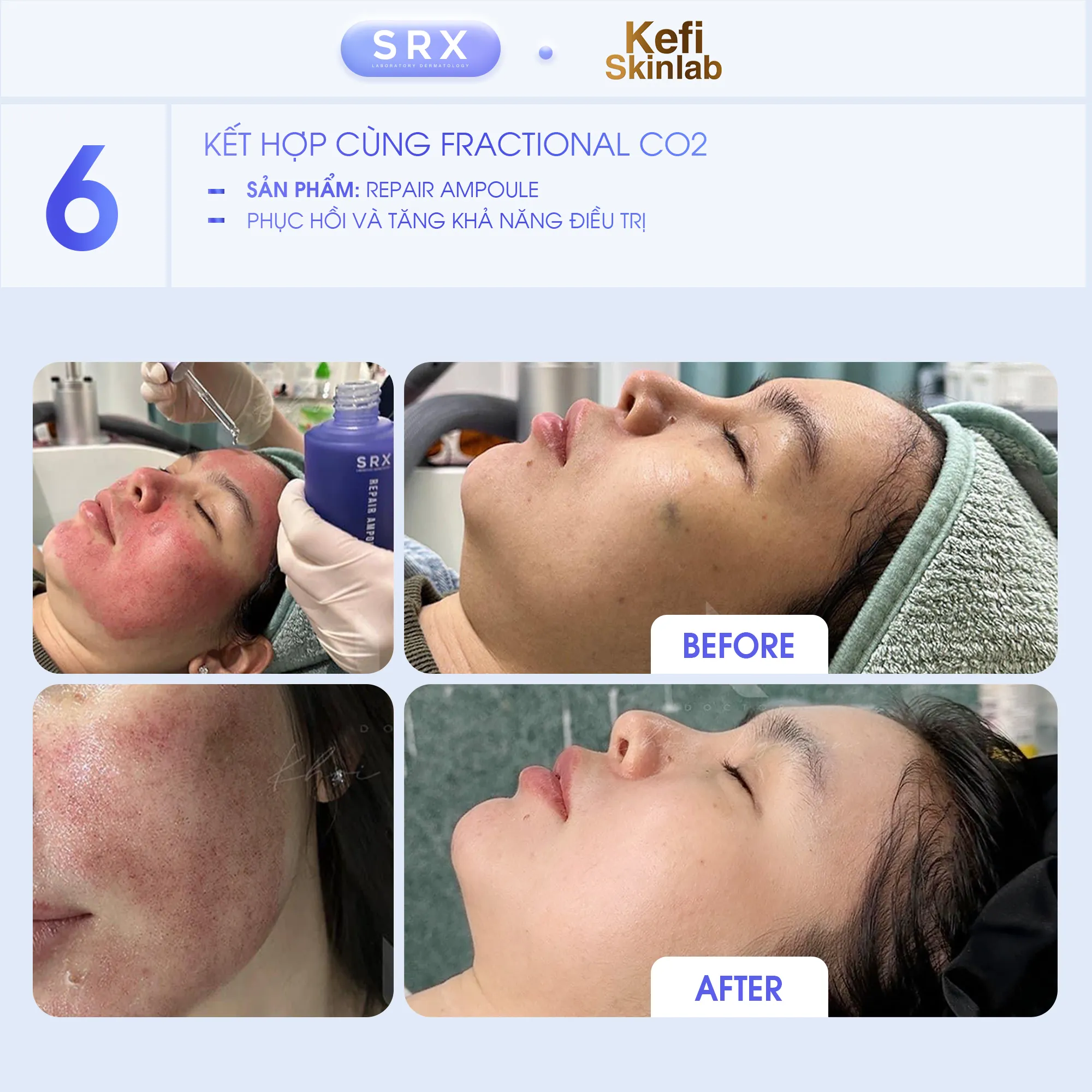 Feedback SRX Case lâm sàng điều trị các vấn đề trên da cùng bộ sản phẩm SRX 8