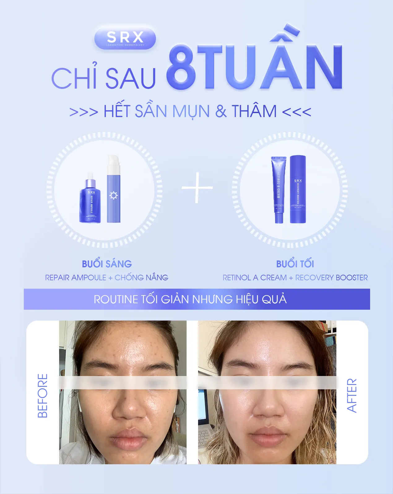 Feedback SRX HẾT SẦN MỤN & THÂM SAU 8 TUẦN